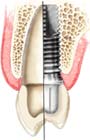 Freedom with Dental Implants